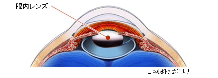 白内障手術内容の画像