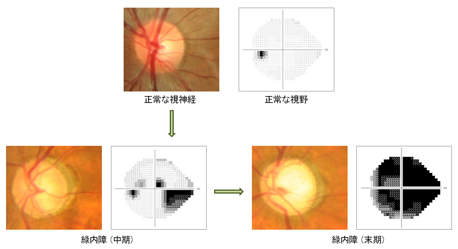 視神経と視野の変化の説明画像