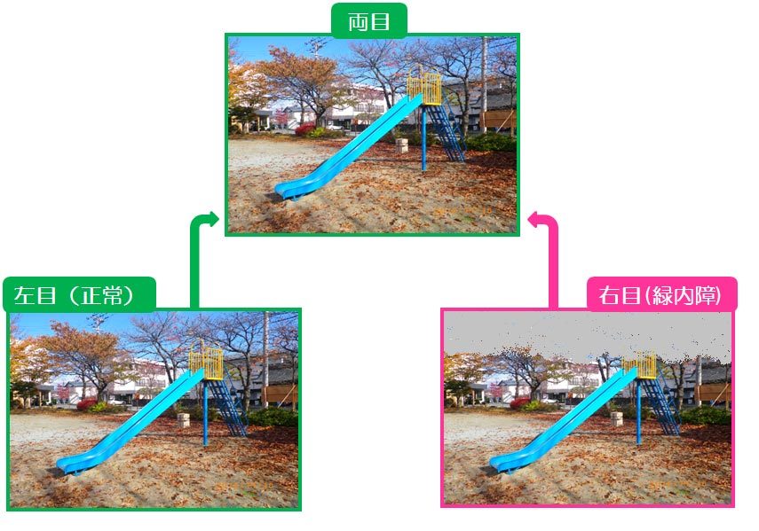 緑内障の視野欠損