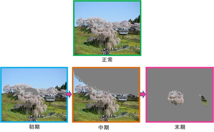 緑内障の視野欠損の説明図